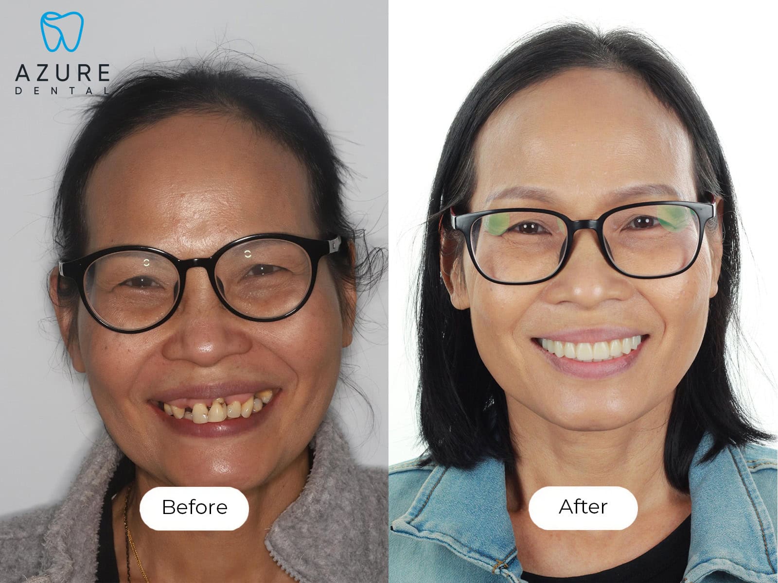 Saichon Smile Gallery